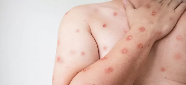 Bahia tem dois casos de Mpox confirmados em 2026