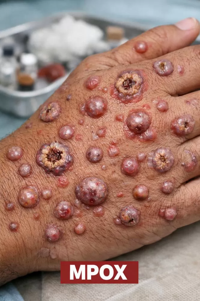 Bahia registra novo caso suspeito de Mpox