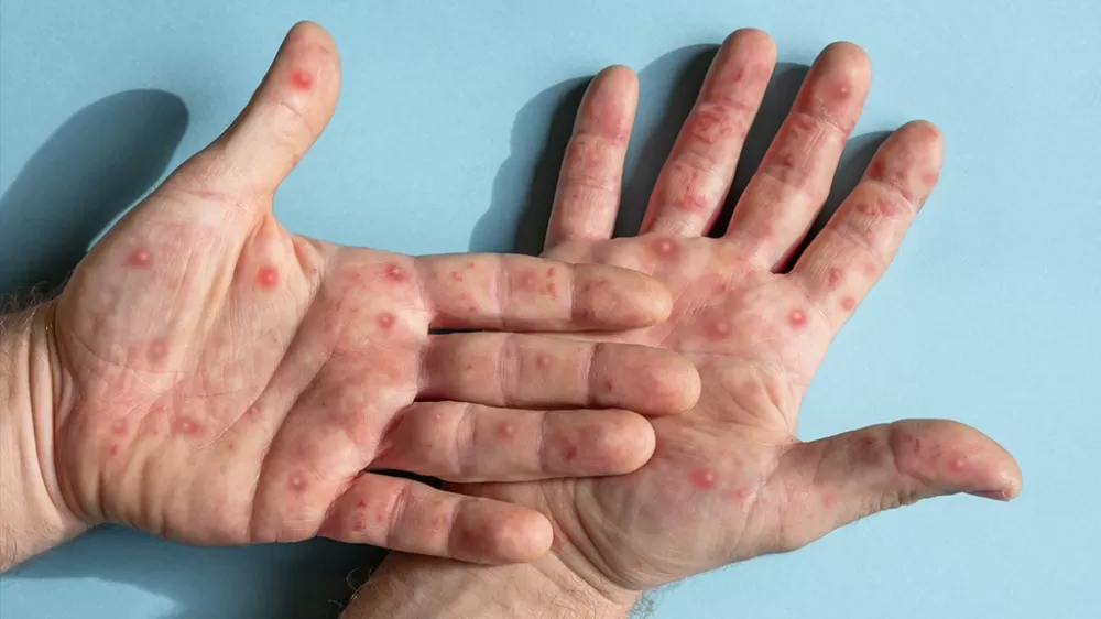 Brasil registra 129 casos confirmados de mpox em 2026